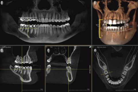 Dr. Zieger Zahnarzt Praxis Bonn Beuel Digitales 3D-Röntgen DVT