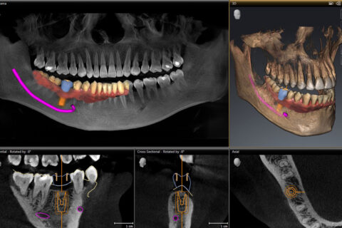 Röntgenbild zeigt eine Lücke wo das Zahnimplantat eingesetzt wird
