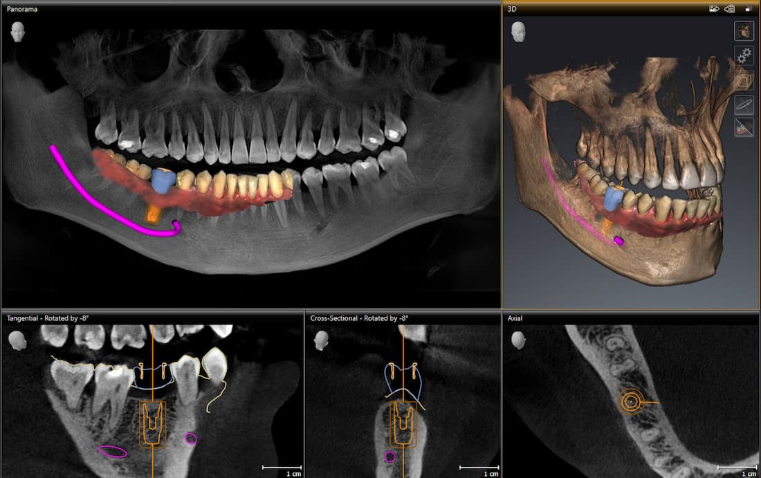 Röntgenbild zeigt eine Lücke wo das Zahnimplantat eingesetzt wird