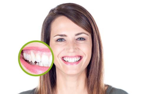 Implantat vs. Zahnbrücke